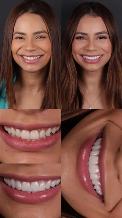 Resultado real 2 - sorriso transformado pela Clínica Viotto