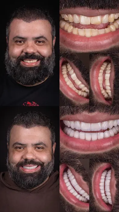 Resultado real 5 - sorriso transformado pela Clínica Viotto