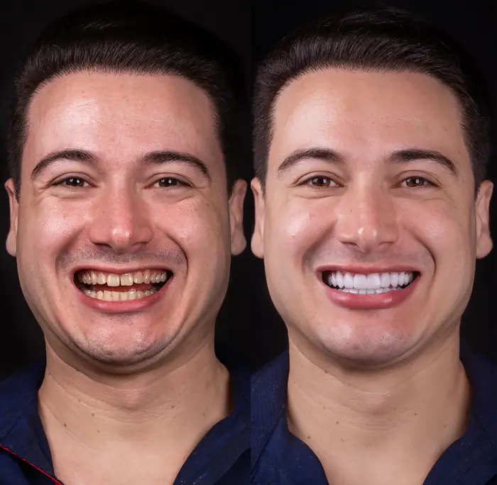 Resultado real 7 - sorriso transformado pela Clínica Viotto