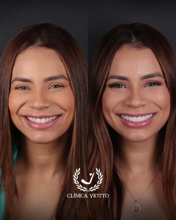 Resultado real 9 - sorriso transformado pela Clínica Viotto