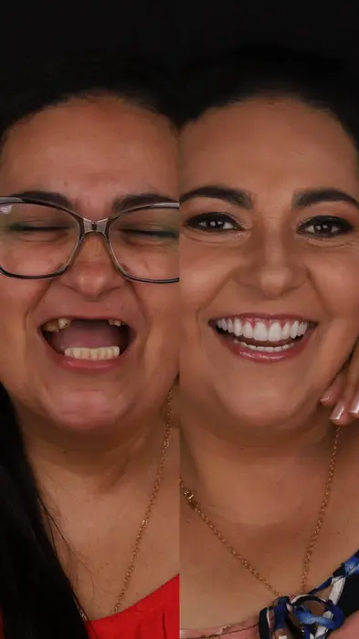 Caso de implante 1 - antes e depois