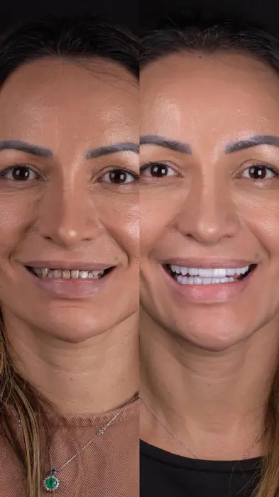 Caso de implante 4 - antes e depois